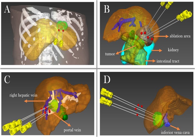 Focused lesion treatment illustration